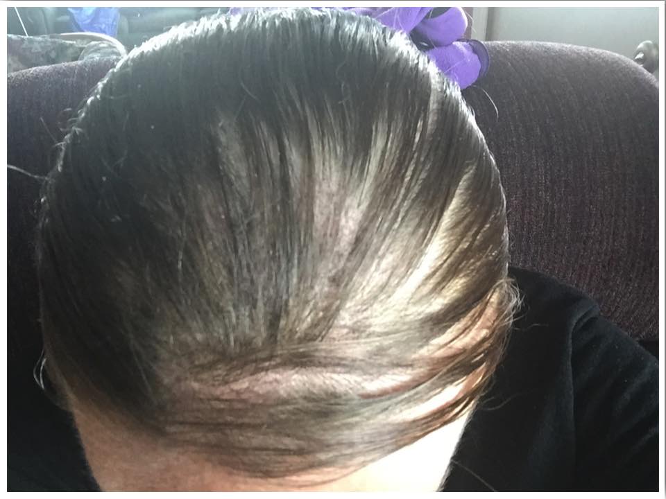 Female hair loss
